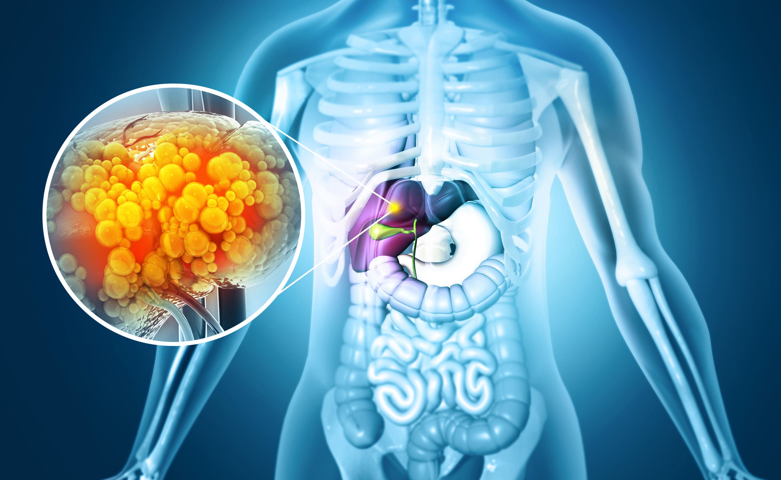 EKU Podcast: Fatty liver disease